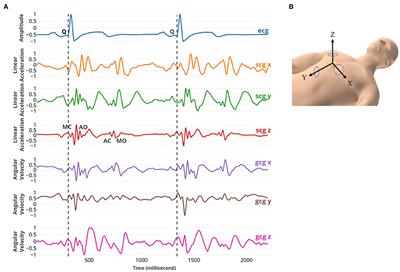 Detecting Coronary Artery Disease Using Rest Seismocardiography and Gyrocardiography